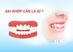 Có nên niềng răng Invisalign không? Ưu nhược điểm chi tiết