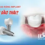Vì sao răng implant bị đào thải?