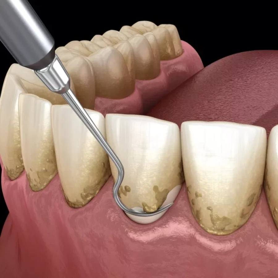 Capital_Dental_Lincoln_Nebraska_Peridontal_Disease_Gum_Disease_2-1024x768