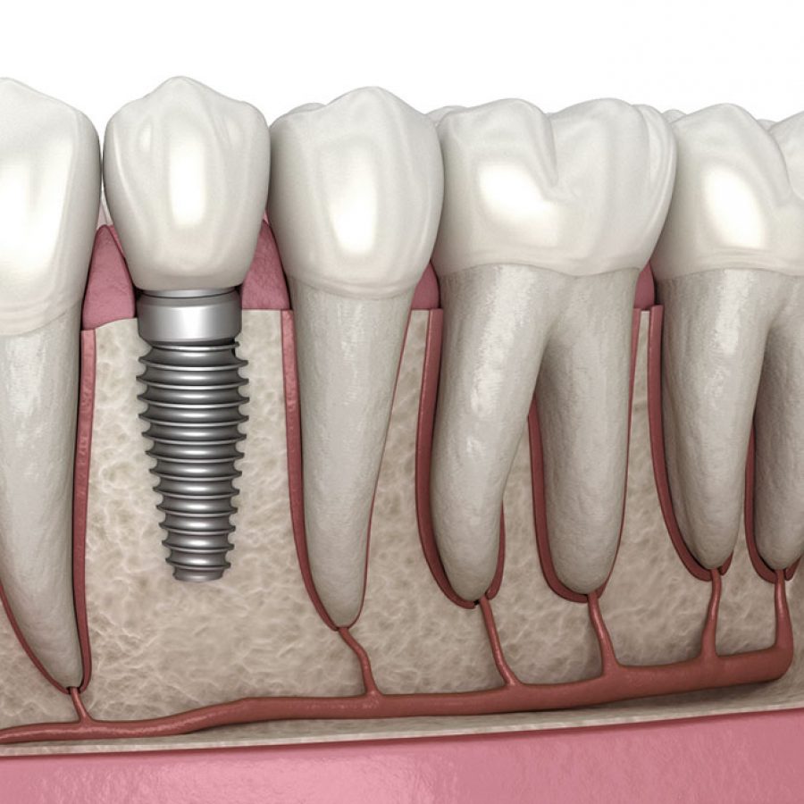 Dental-implant-illustration