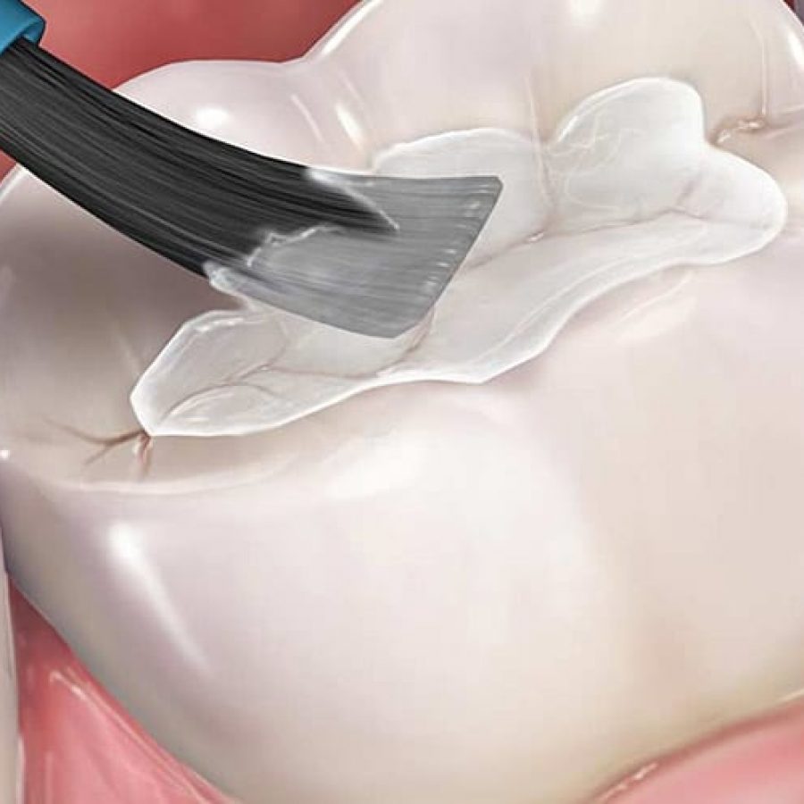 DentalSealants