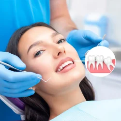 Nhổ-răng-khôn