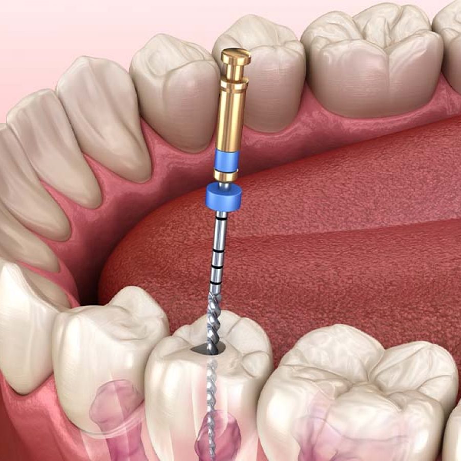 Root-Canal-Blog