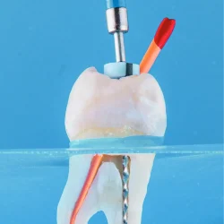 Root Canal Therapy