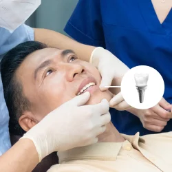 Trong-rang-Implant-2