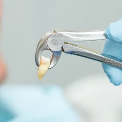 Wisdom Tooth Extraction