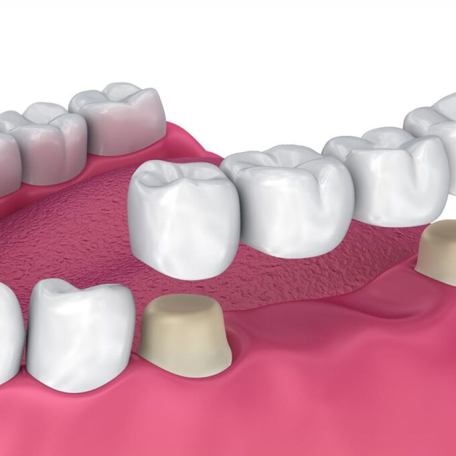 dental-bridges-1080x675