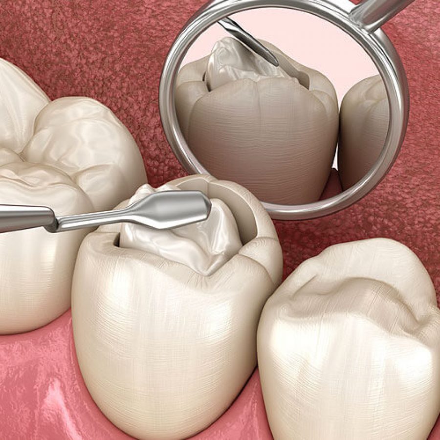 img-Composite-Fillings-Procedure-Problems-Maintenance