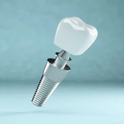 trong rang implant_8_11zon